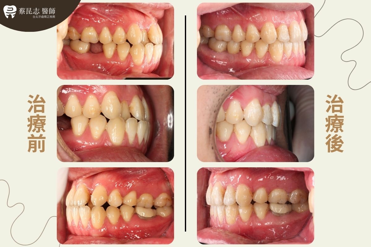 【牙齒矯正】下嘴唇外凸齒列擁擠不對稱拔牙 3 asymmetric tooth extraction 3 1