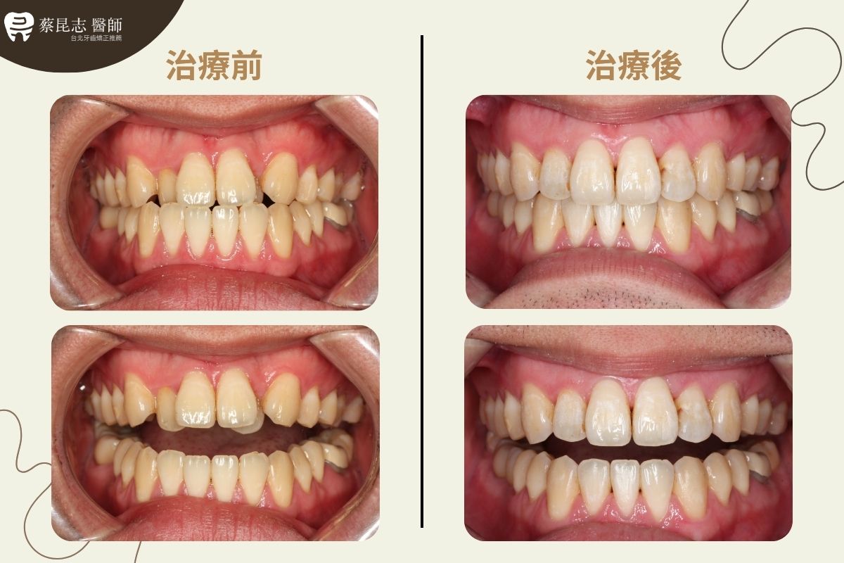 【牙齒矯正】下嘴唇外凸齒列擁擠不對稱拔牙 4 asymmetric tooth extraction 4 1