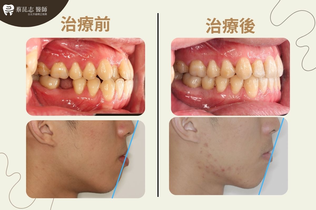 【牙齒矯正】下嘴唇外凸齒列擁擠不對稱拔牙 5 asymmetric tooth extraction 5 1