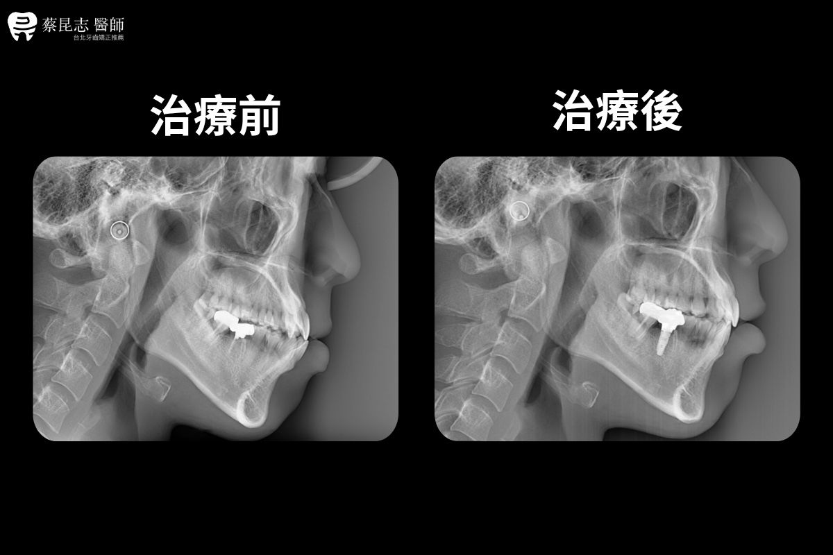 【牙齒矯正】下嘴唇外凸齒列擁擠不對稱拔牙 6 asymmetric tooth extraction 6 1