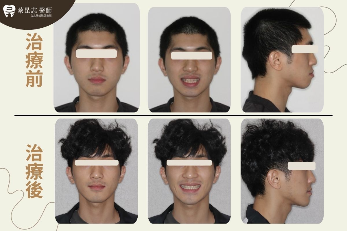 【牙齒矯正】下嘴唇外凸齒列擁擠拔牙 1 tooth extraction for crowding 1