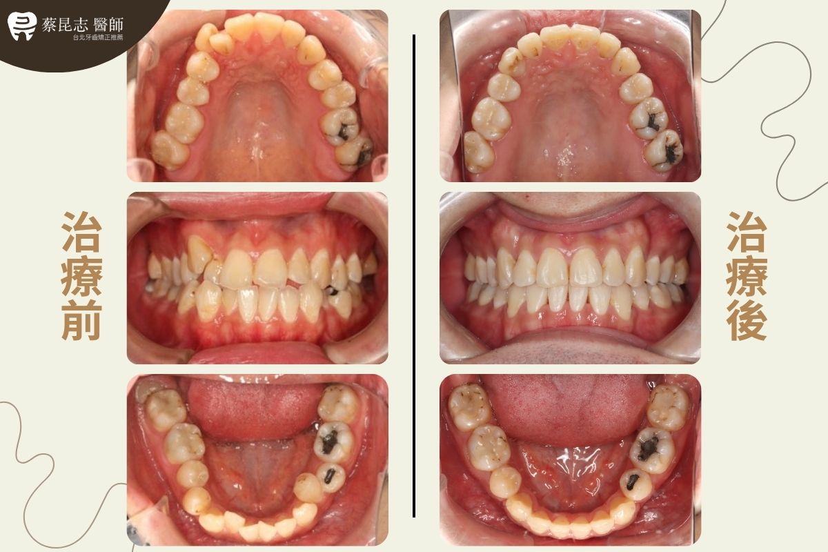 【牙齒矯正】下嘴唇外凸齒列擁擠拔牙 2 tooth extraction for crowding 2