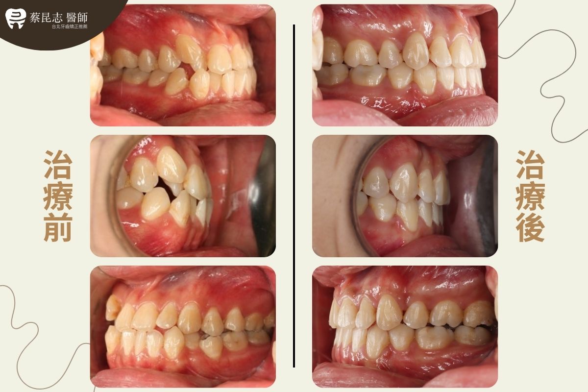 【牙齒矯正】下嘴唇外凸齒列擁擠拔牙 3 tooth extraction for crowding 3