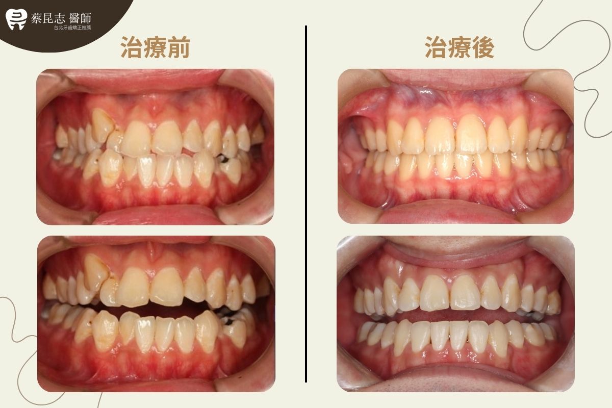 【牙齒矯正】下嘴唇外凸齒列擁擠拔牙 4 tooth extraction for crowding 4 1