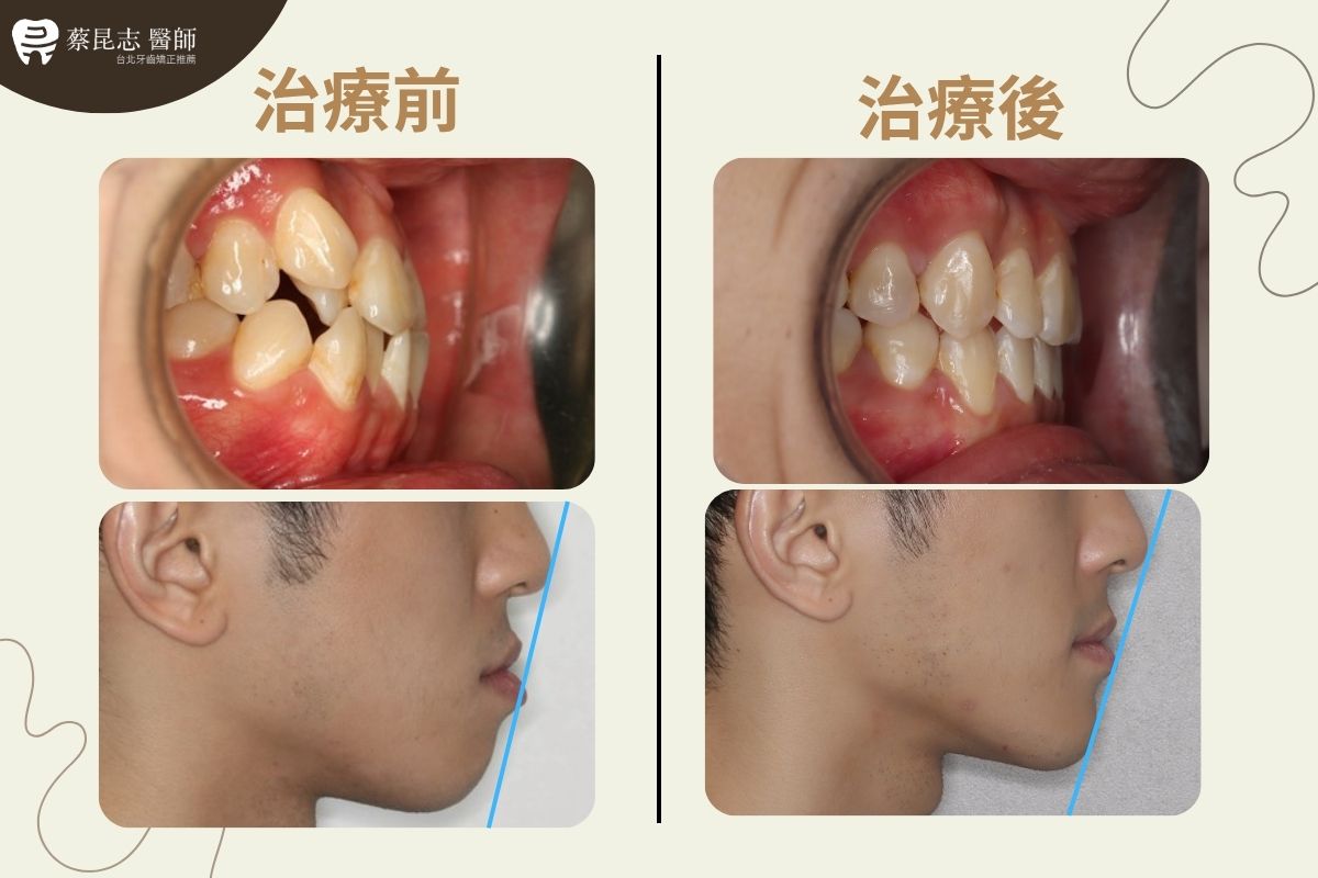 【牙齒矯正】下嘴唇外凸齒列擁擠拔牙 5 tooth extraction for crowding 5