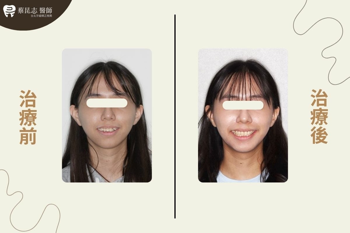 齒列擁擠 合併暴牙和開咬 拔牙治療-正面照