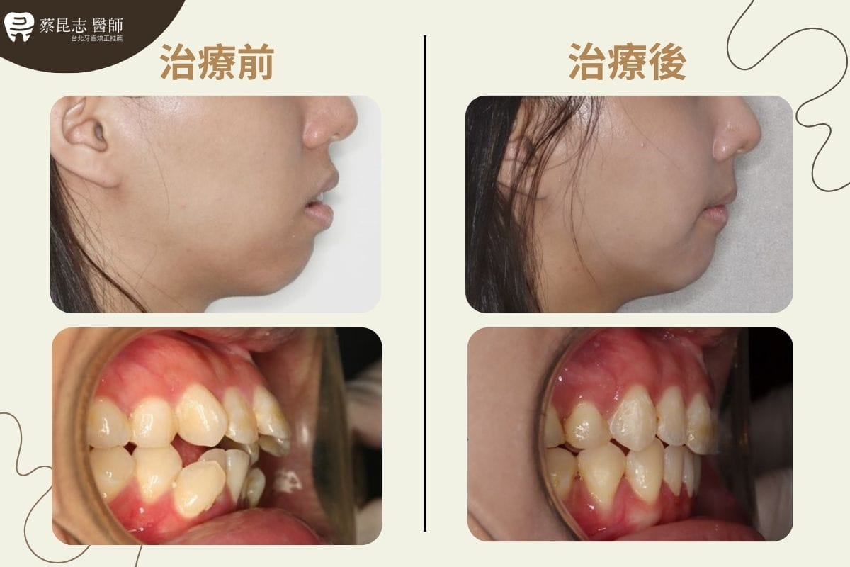 齒列擁擠 合併暴牙和開咬 拔牙治療-臉齒側面照