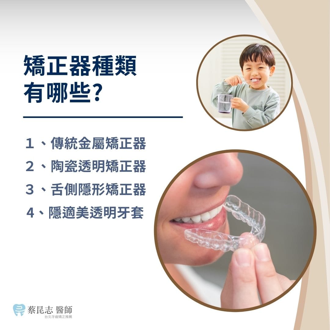 矯正器種類有哪些？