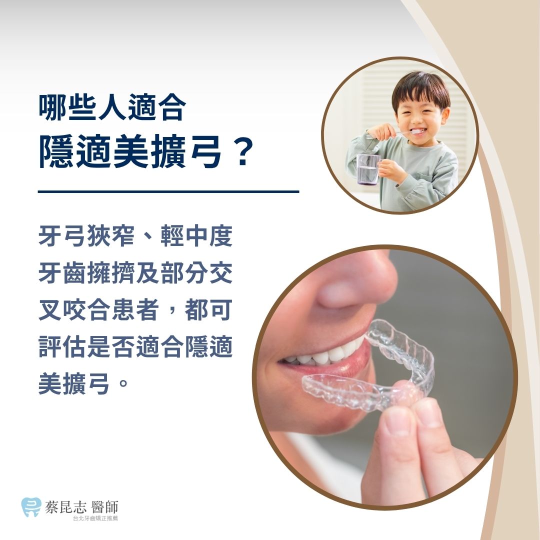 哪些人適合隱適美擴弓？